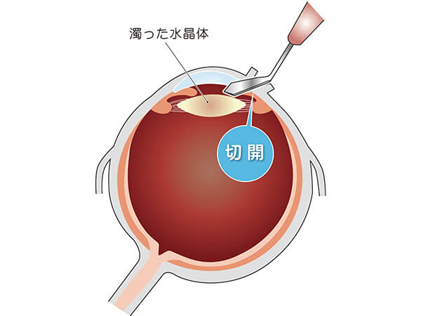 【画像】眼球の切開