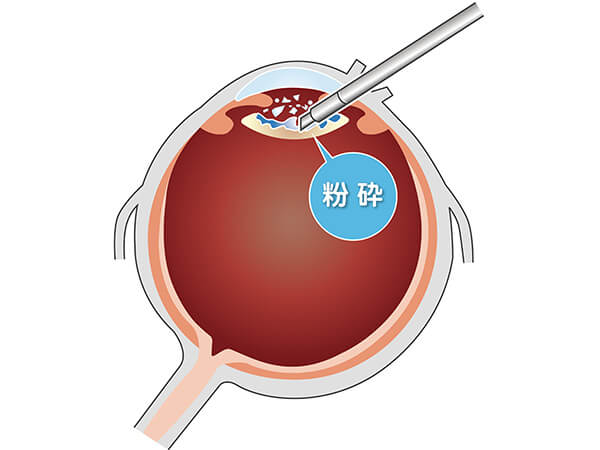 【画像】眼球の切開