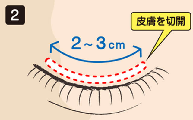 イメージ：皮膚切開