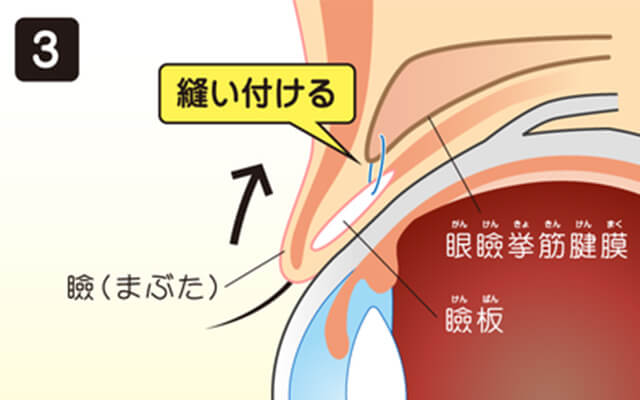 イメージ：瞼の短縮