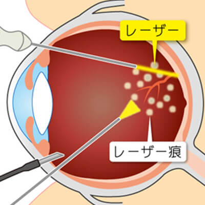 イメージ：硝子体手術