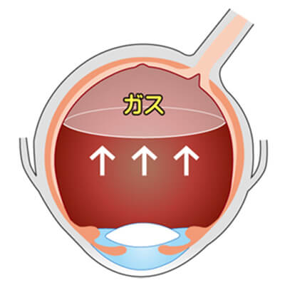 イメージ：硝子体手術