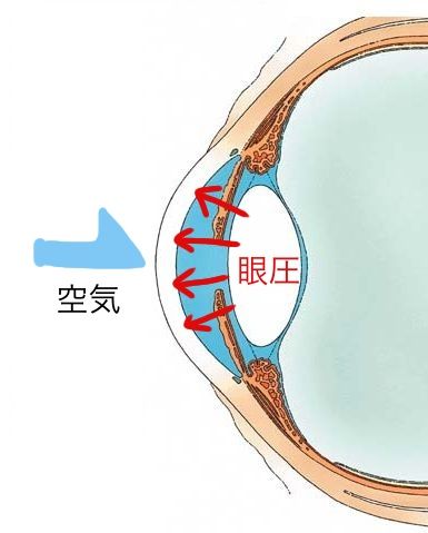 ノンコント眼圧