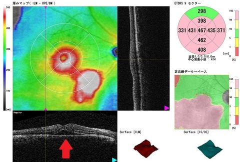 BRVO1 OCT macular thickness0131 resized