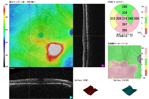 BRVO1 OCT macular thickness 2 resized