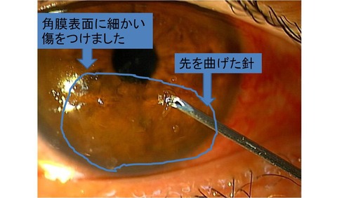 再発性　パンクチャー改