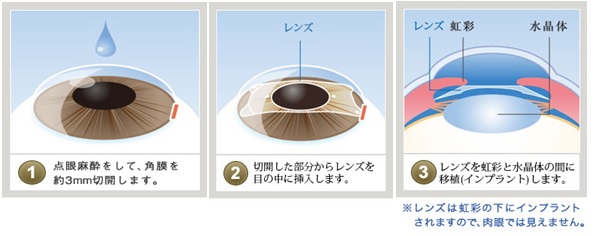 手術ｔｅｃｈｎｉｑｕｅ