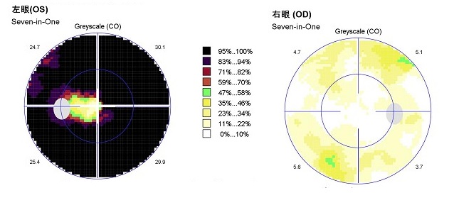 左緑内障発作後視野