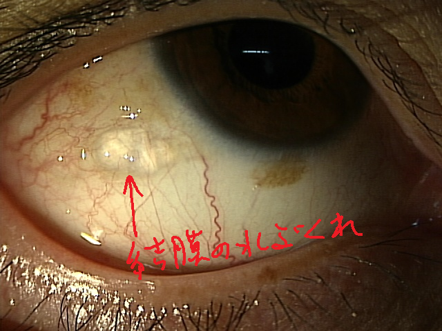 眼球 に 水ぶくれ